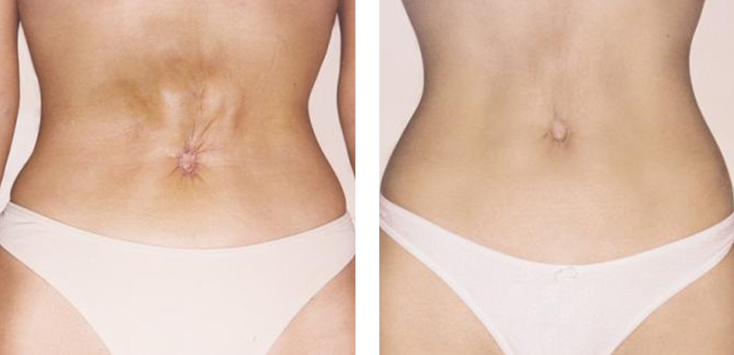 Behandlung Hautstraffung